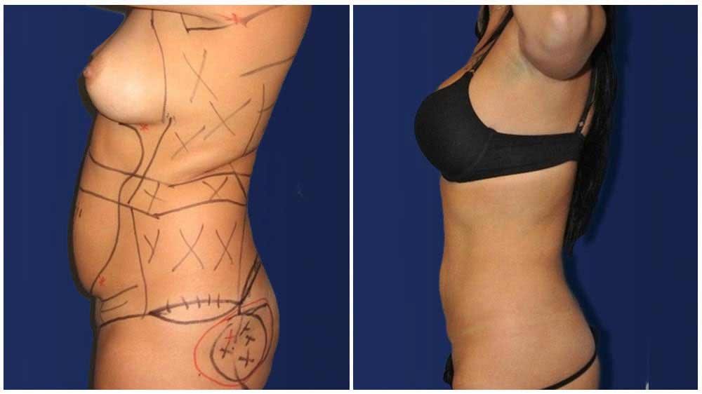 Fat Transfer of a Fort Worth Liposuction Specialty Clinic Female Patient - (30 years)